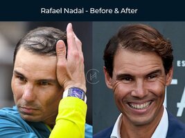 Rafael-Nadal-Hair-Transplant-Before-After.jpg